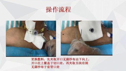 成人黑管的包扎方法视频,视频教程详解